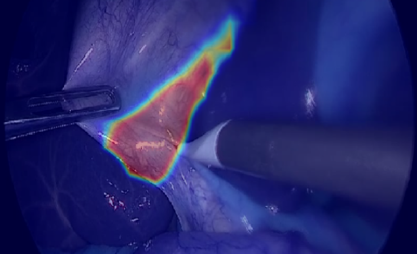 Blog post AI for achieving Critical View of Safety in Laparoscopic Cholecystectomy Videos main image